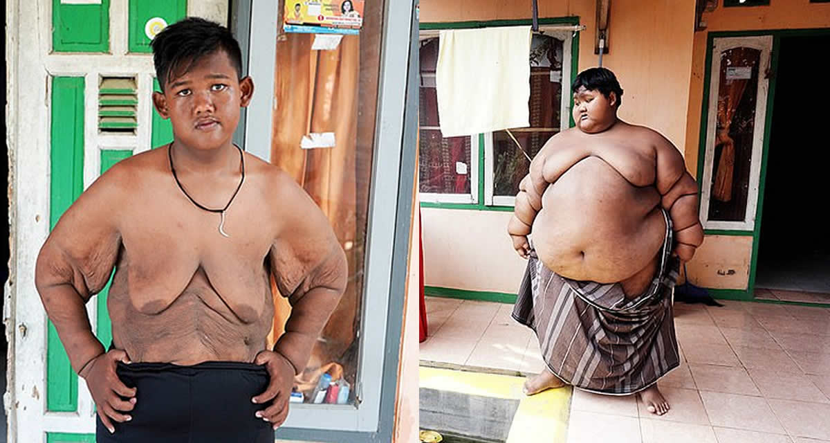 Photo world’s heaviest child loses an incredible 100kg, now weighs